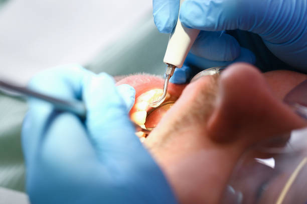 Best Emergency Dental Extractions in Pinehurst, NC